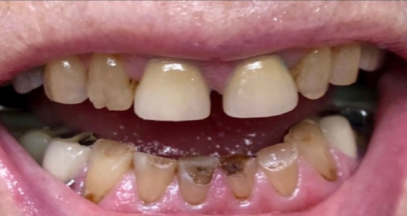 Close-up of a person's mouth showing unhealthy teeth with decay and discoloration.