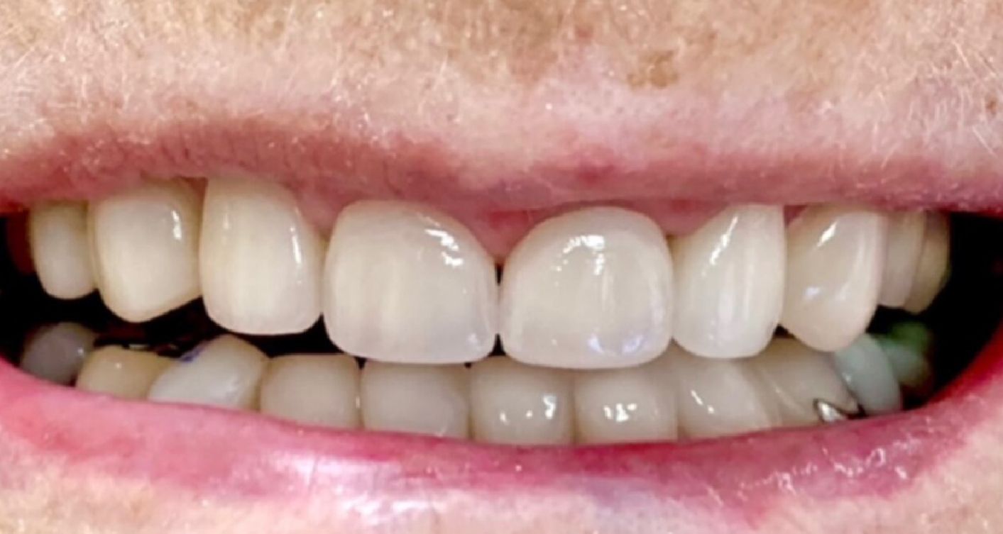 Close-up of a person's smiling mouth, showing bright white teeth. Pink lips and gums are visible.