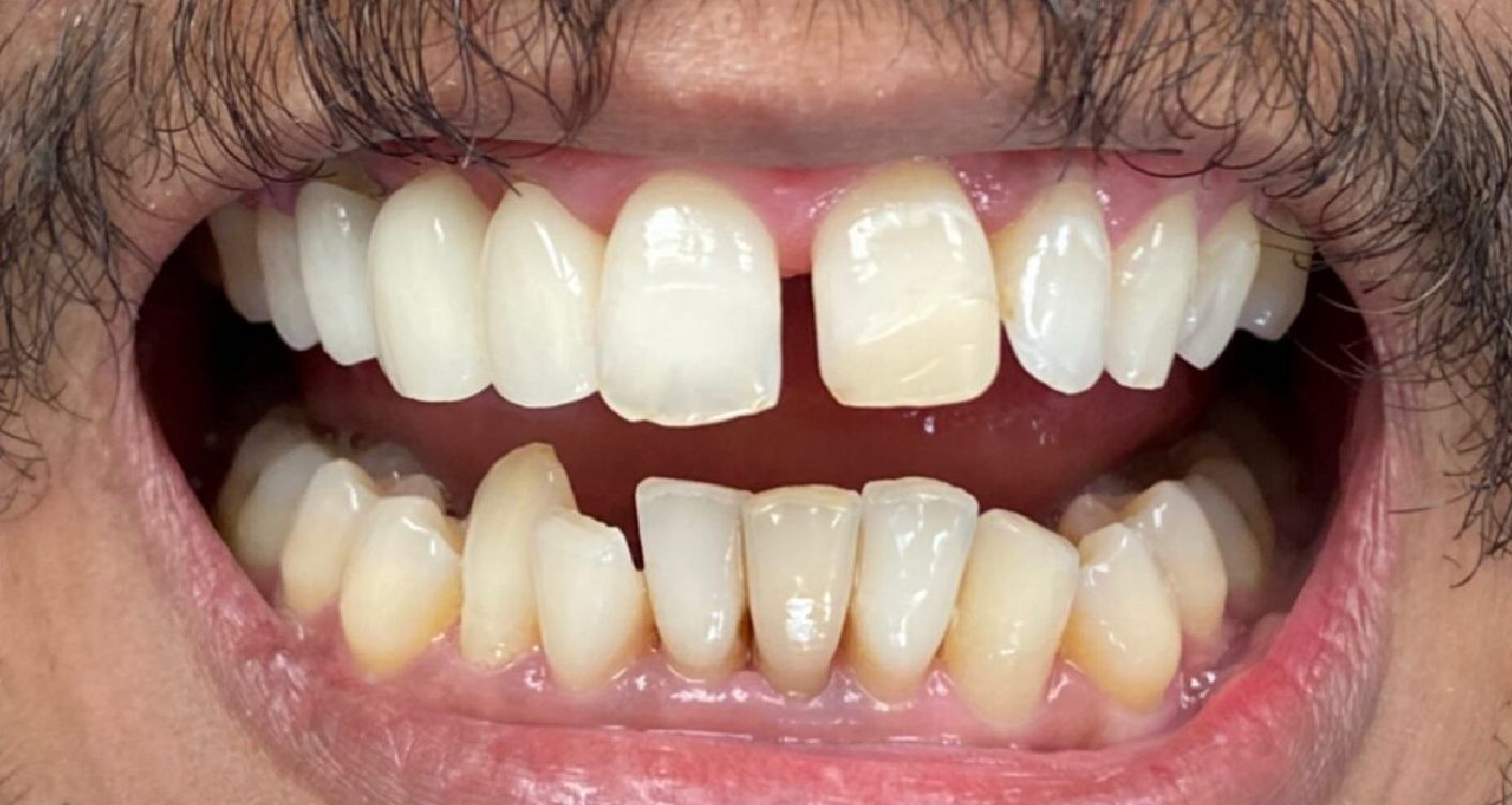 Close-up of a man's mouth, showing teeth with noticeable gaps, including a prominent space between the front teeth.
