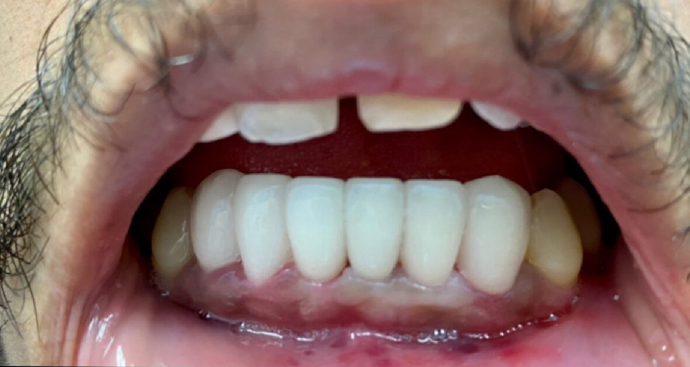 Close-up of a person's mouth, showing white teeth and a pink gum line. The upper front teeth have a slight gap.