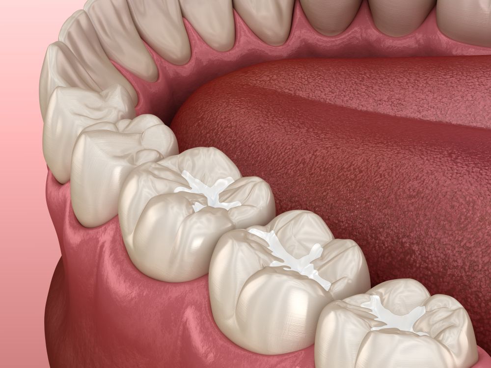 Mouth interior showing molars with white fillings against pink gums and tongue.