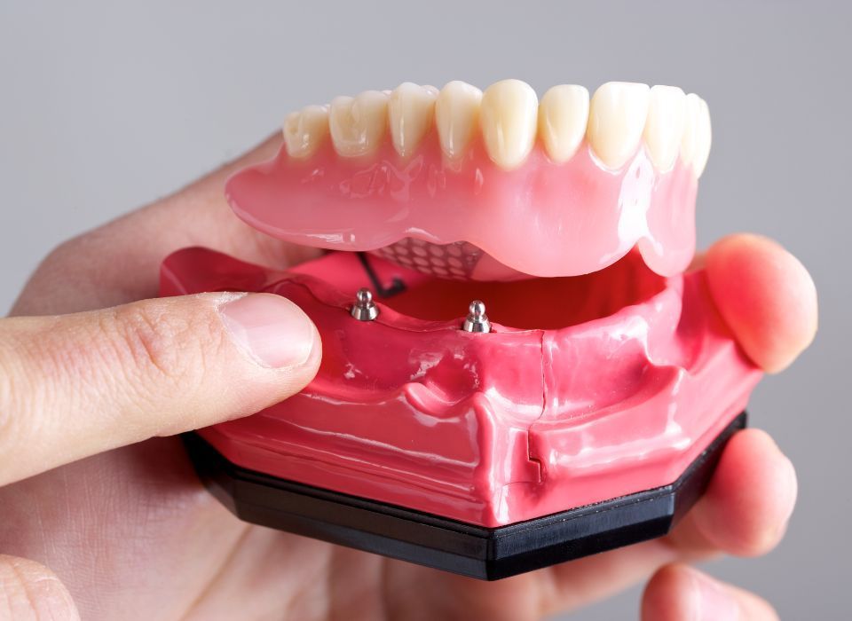 Dental implants supporting a set of upper and lower dentures. Pink gums with white teeth are visible.