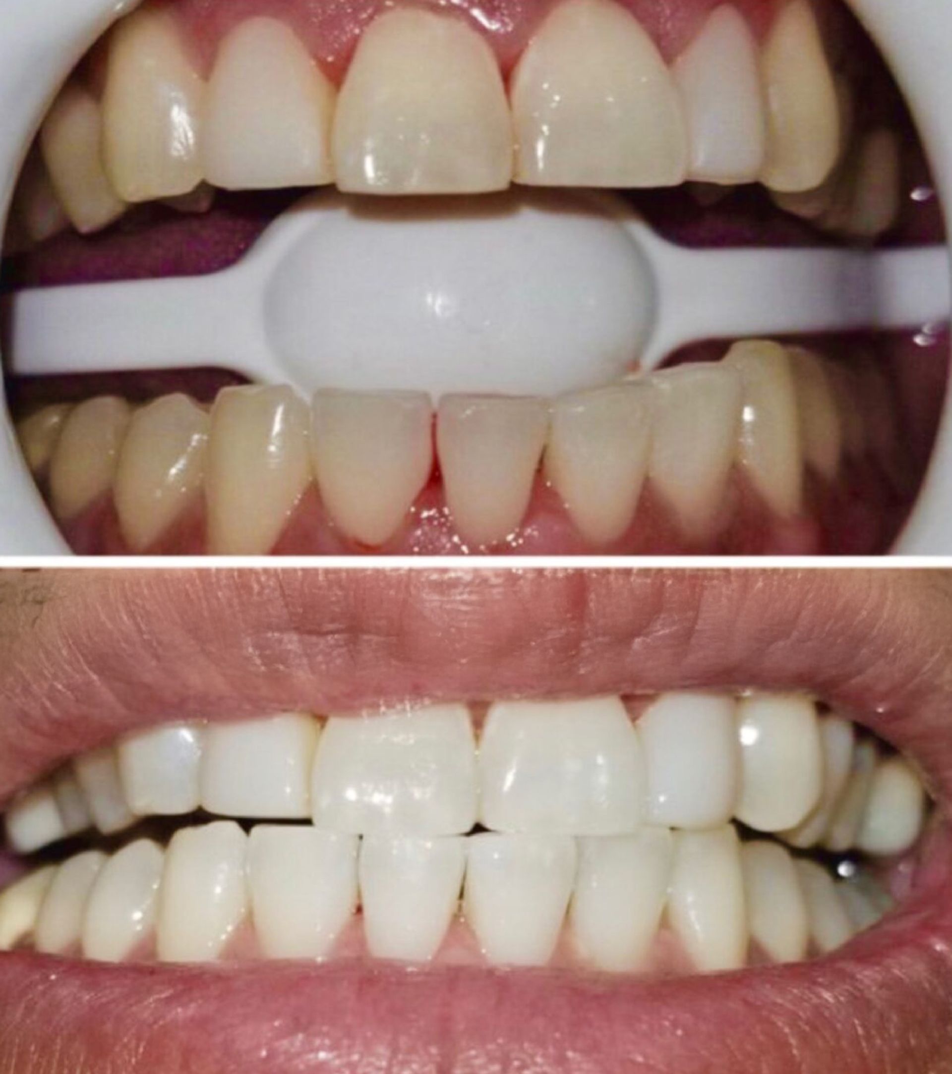 Before and after teeth whitening: top image shows teeth with whitening tray, bottom shows whiter teeth.
