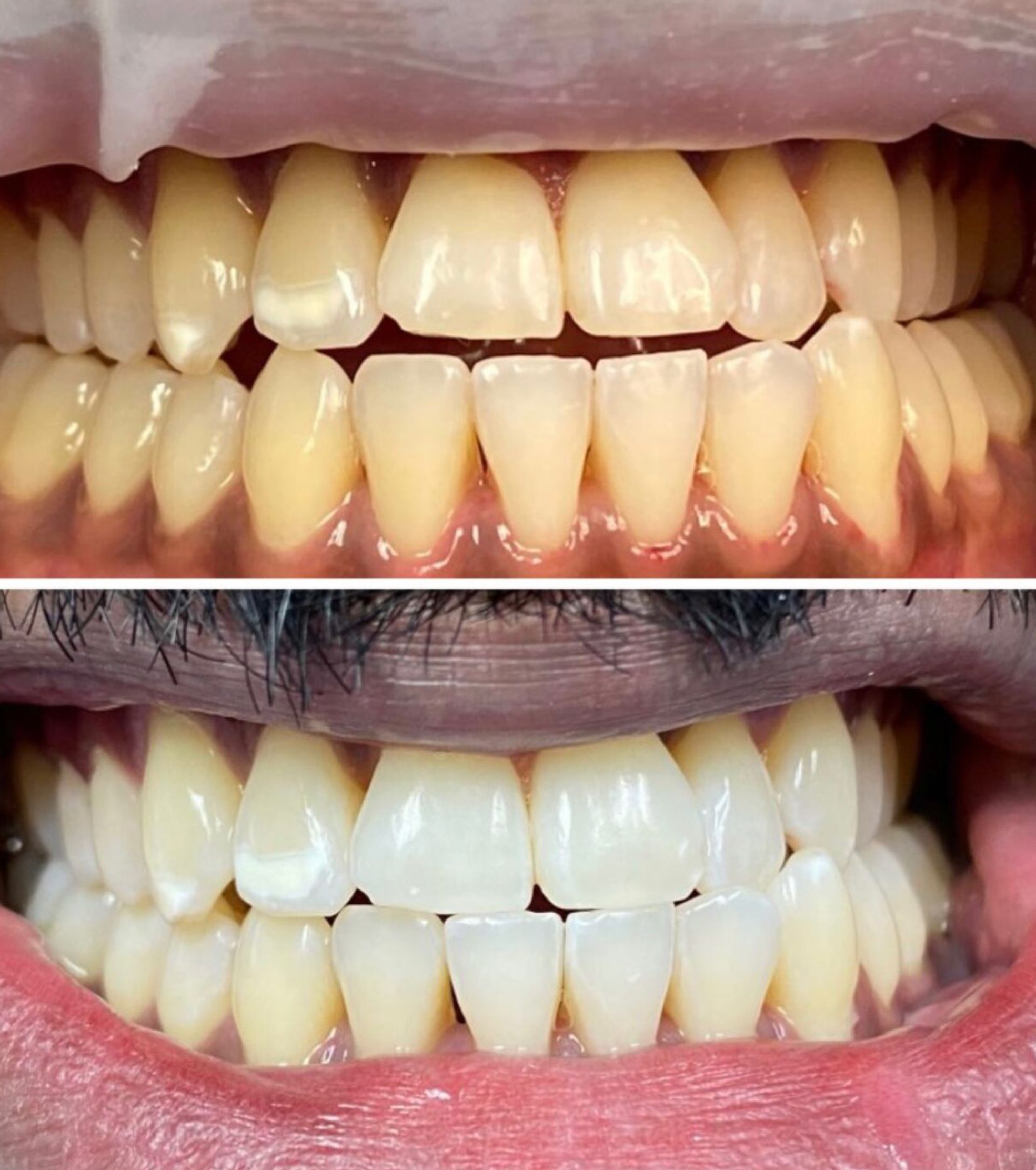 Side-by-side comparison: yellow teeth before and bright white teeth after whitening.