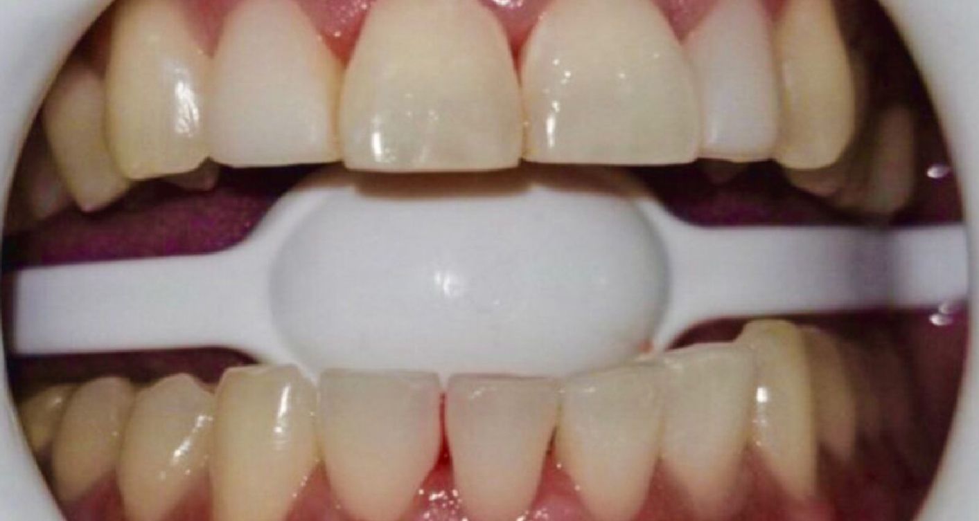 Teeth being examined; a white dental retractor keeps mouth open.