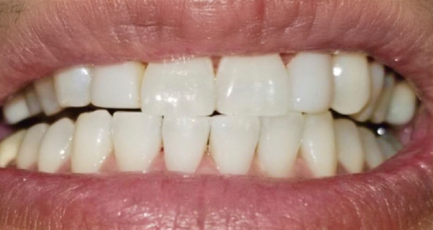 Close-up of a person's mouth showing a row of bright, white teeth.