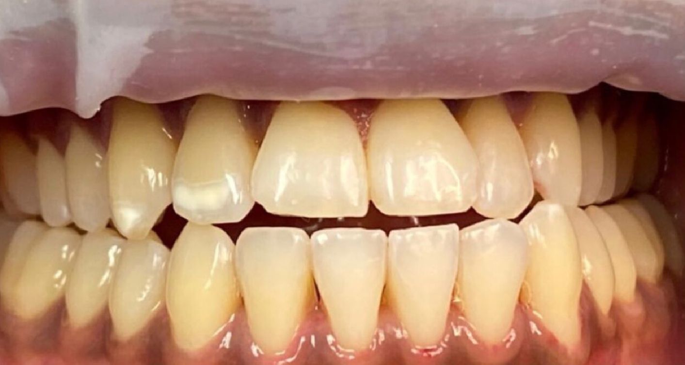 Close-up view of a person's teeth. The upper and lower teeth are visible, some yellowing.