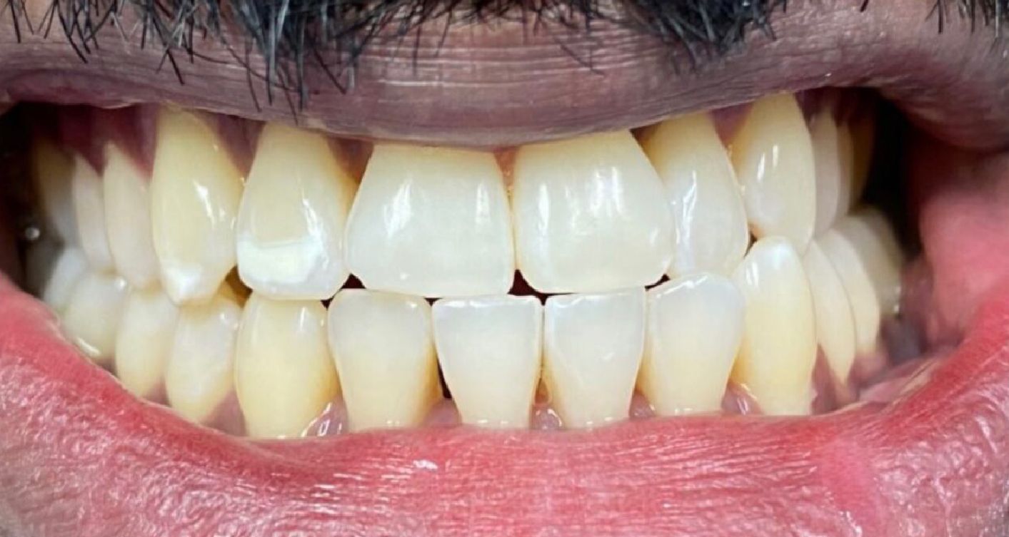 Close-up of a person's teeth, showing slightly yellowed, well-aligned teeth.
