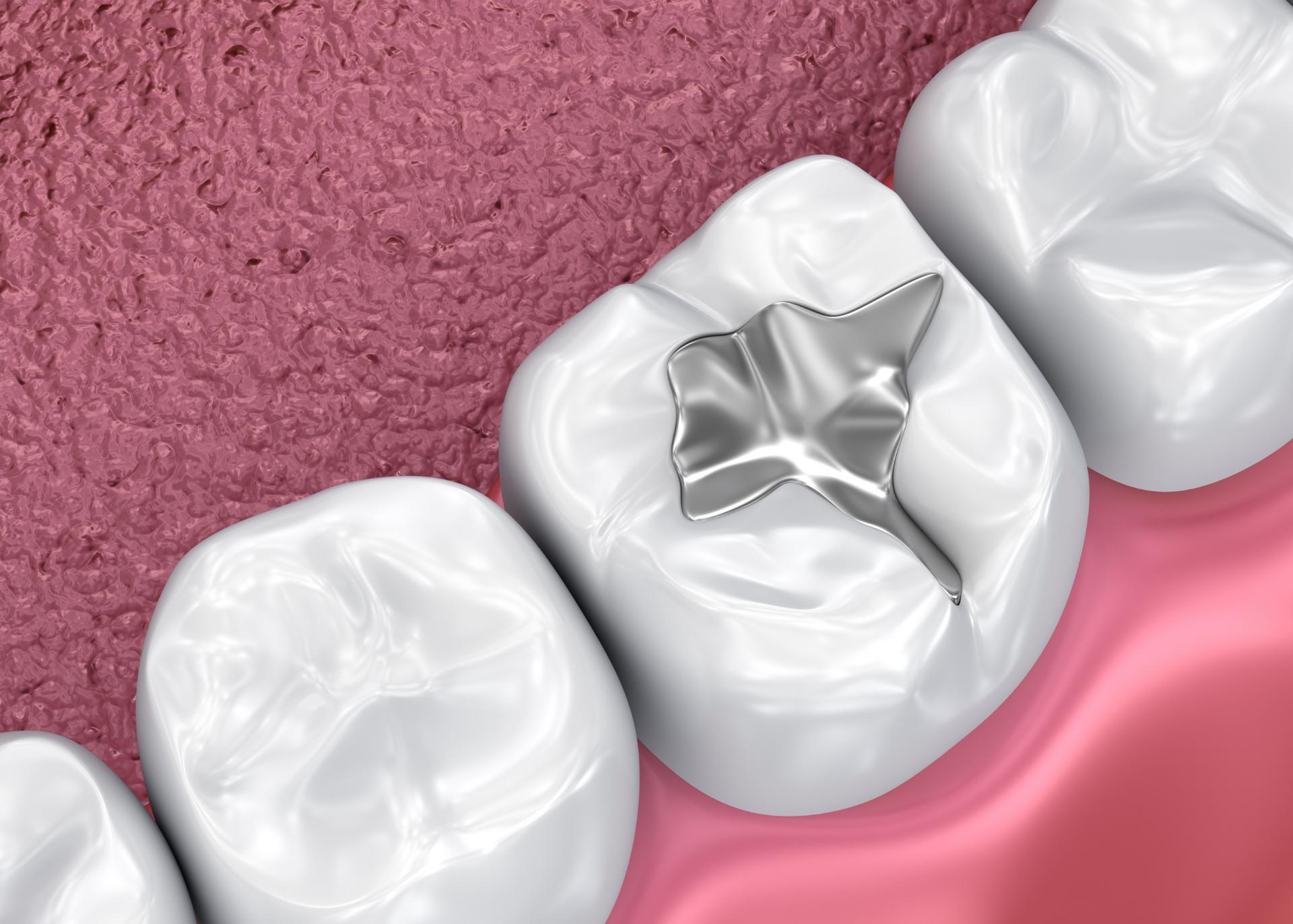 Tooth with a silver amalgam dental filling in the center, surrounded by healthy teeth and gums.