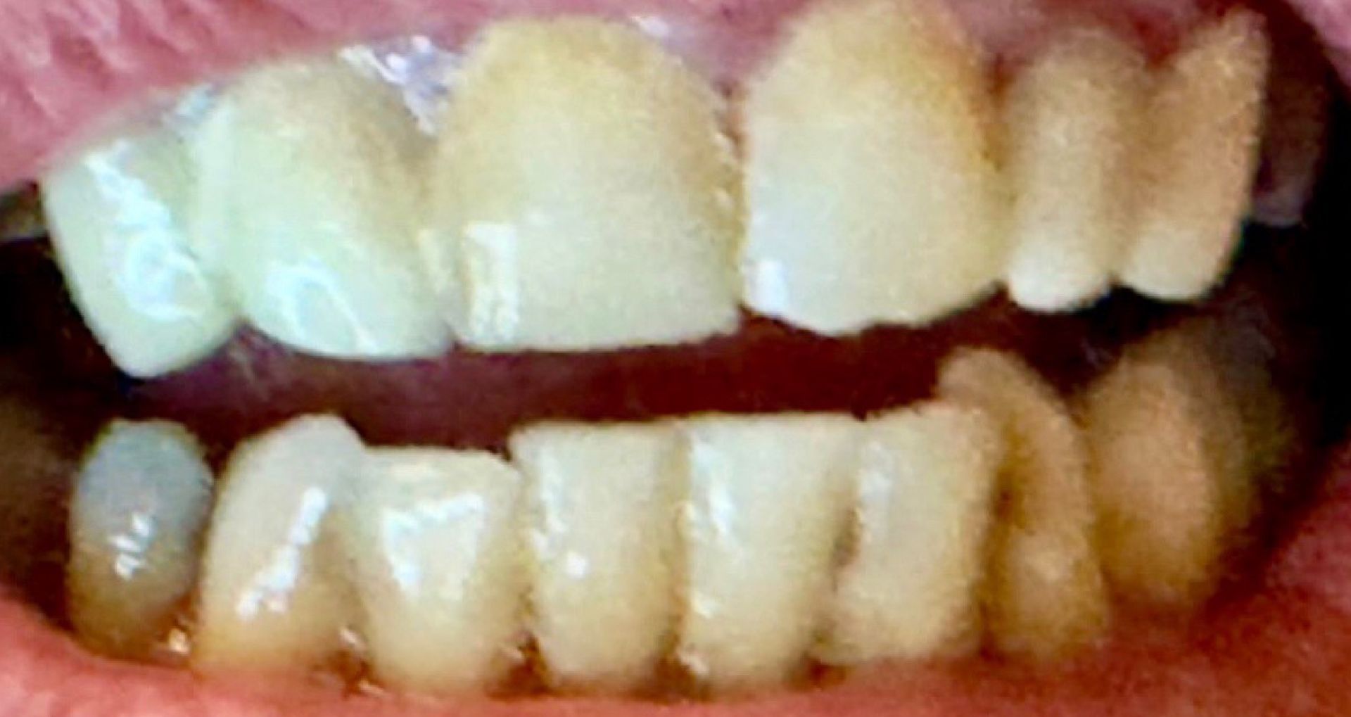 Close-up of teeth showing a gap between the top front teeth.