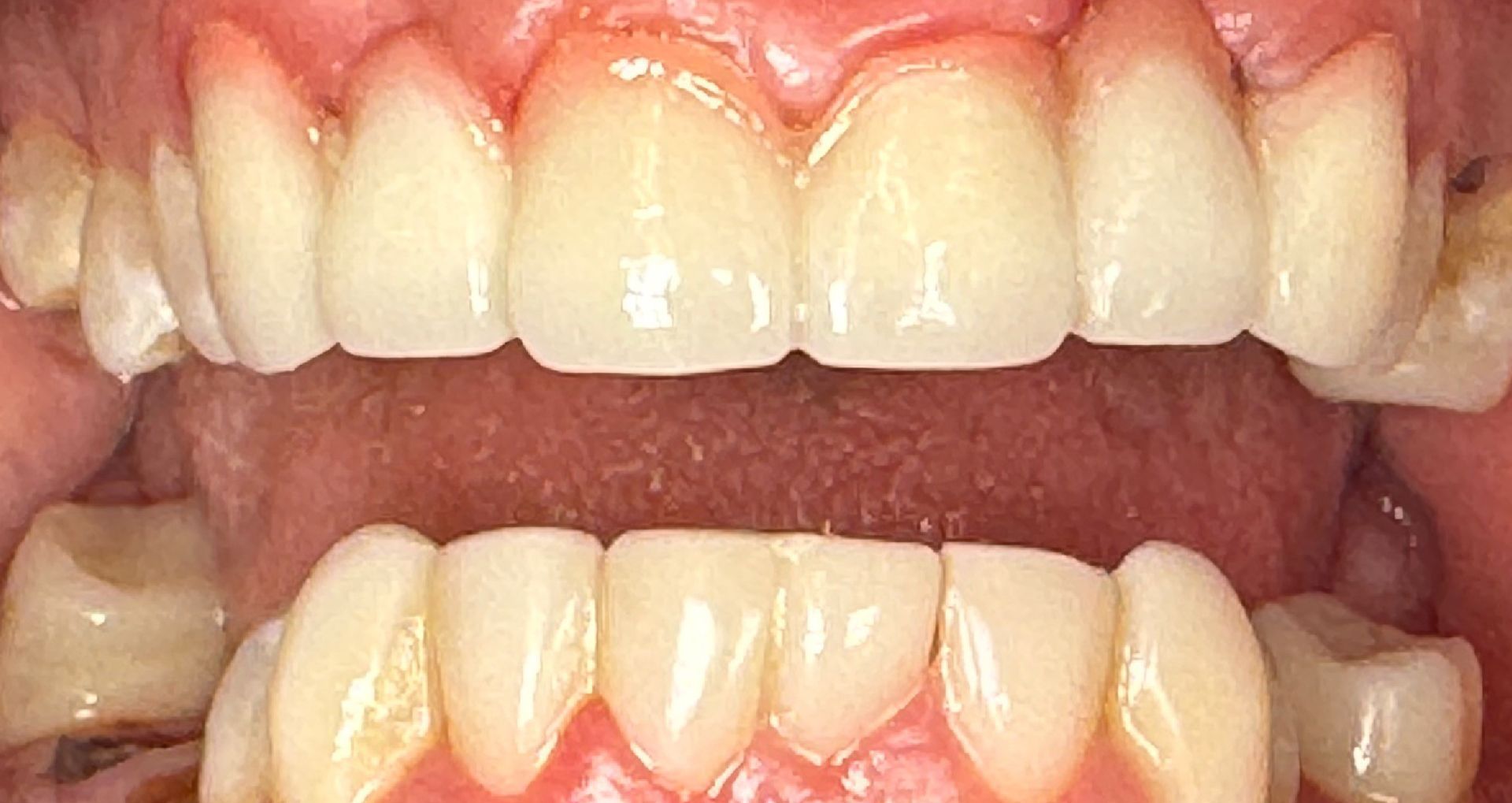 Close-up of teeth showing uneven wear and slight misalignment; mostly white with pink gums.