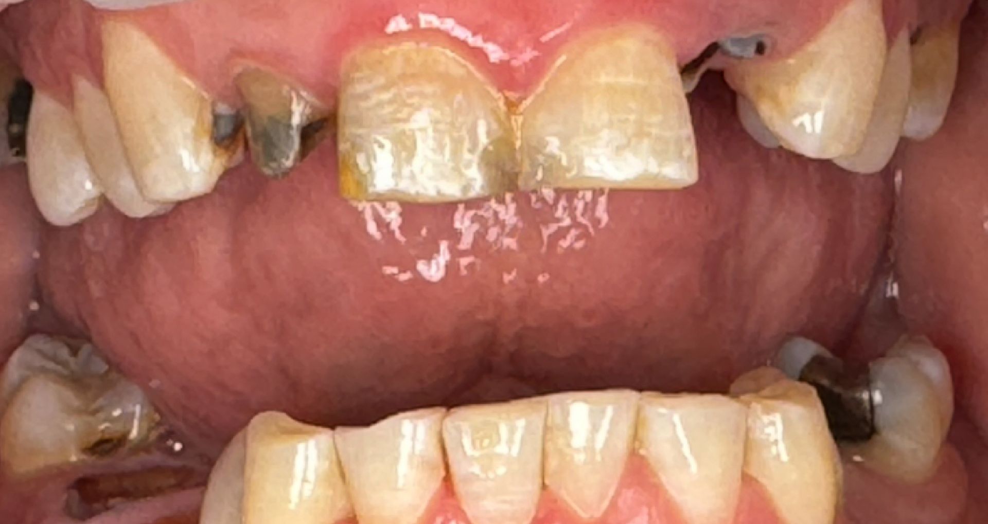 Close-up of teeth showing a gap between the top front teeth.