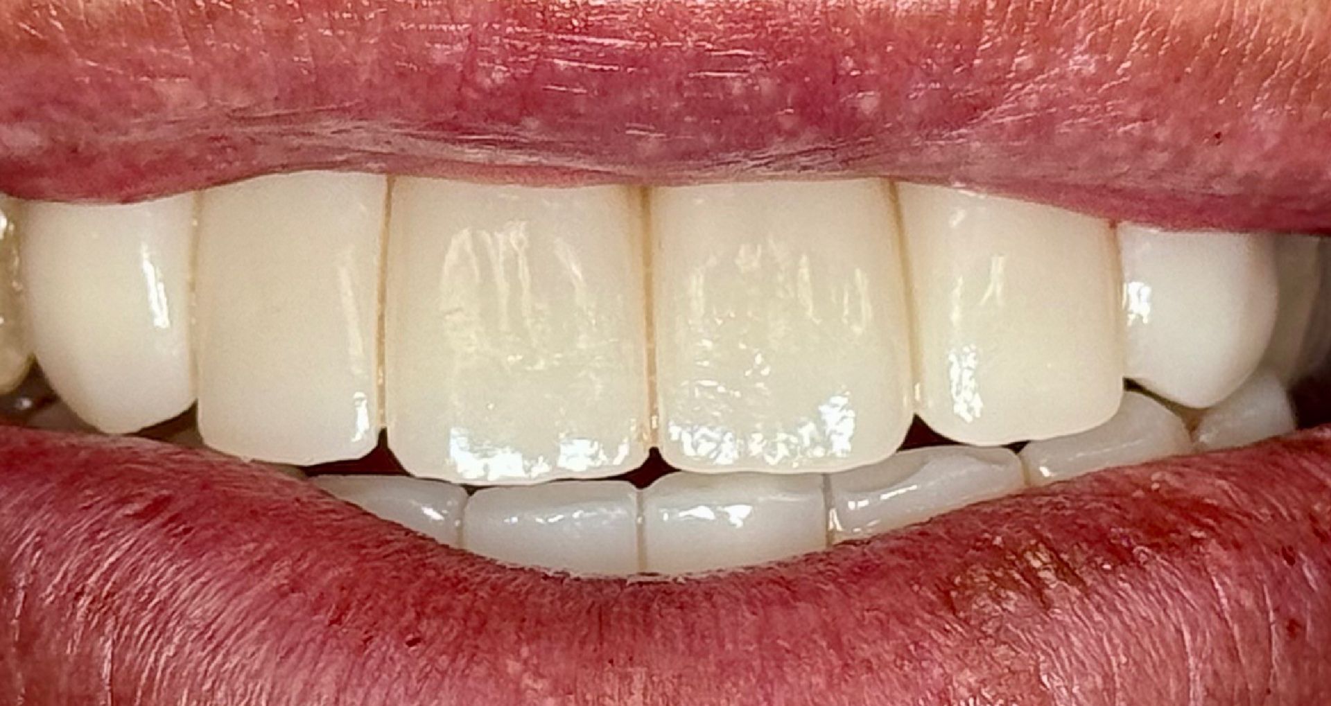 Close-up of teeth showing uneven wear and slight misalignment; mostly white with pink gums.