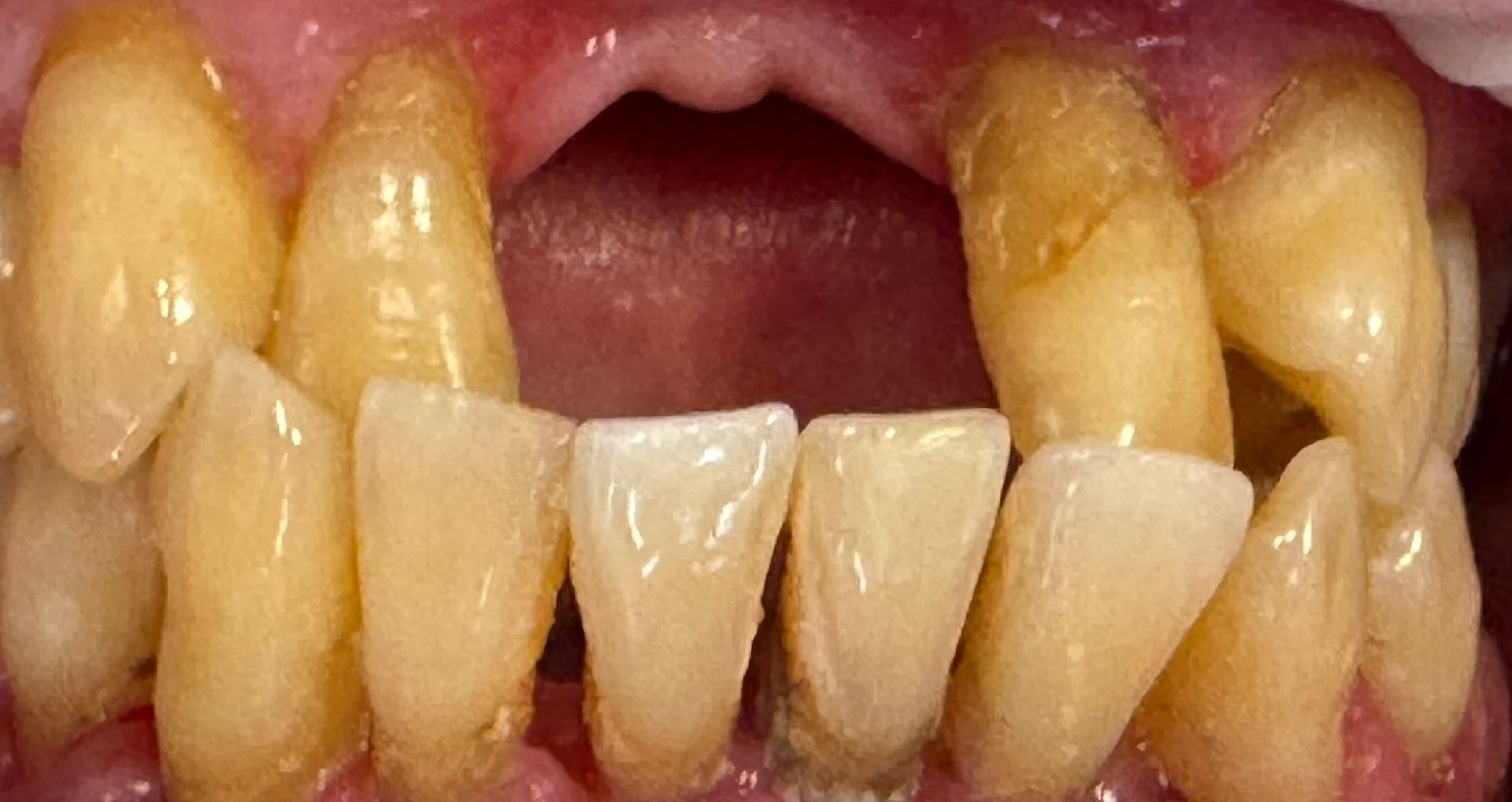 Close-up of teeth showing a gap between the top front teeth.