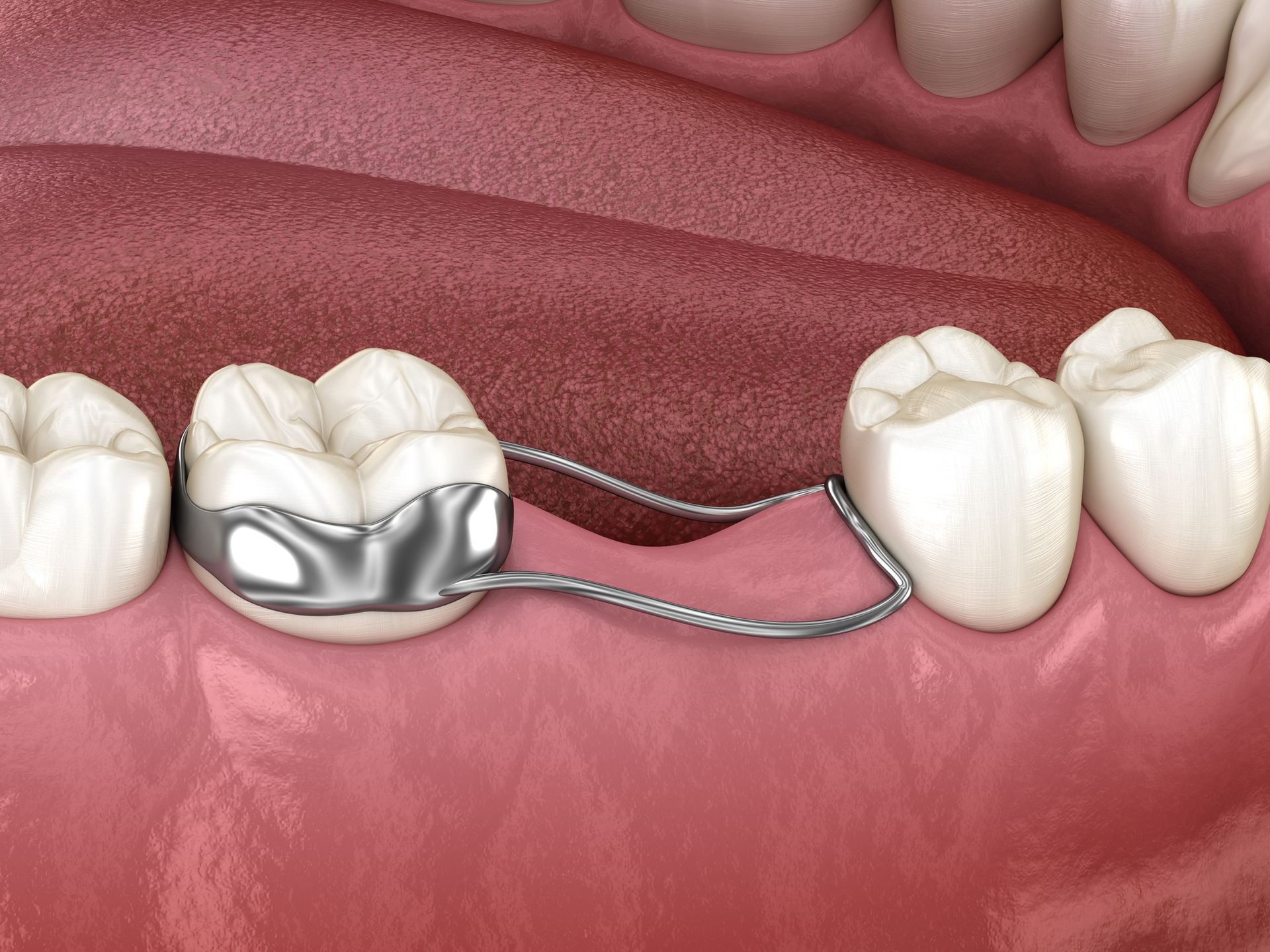 Close-up of a dental appliance, a space maintainer, holding space for a tooth.