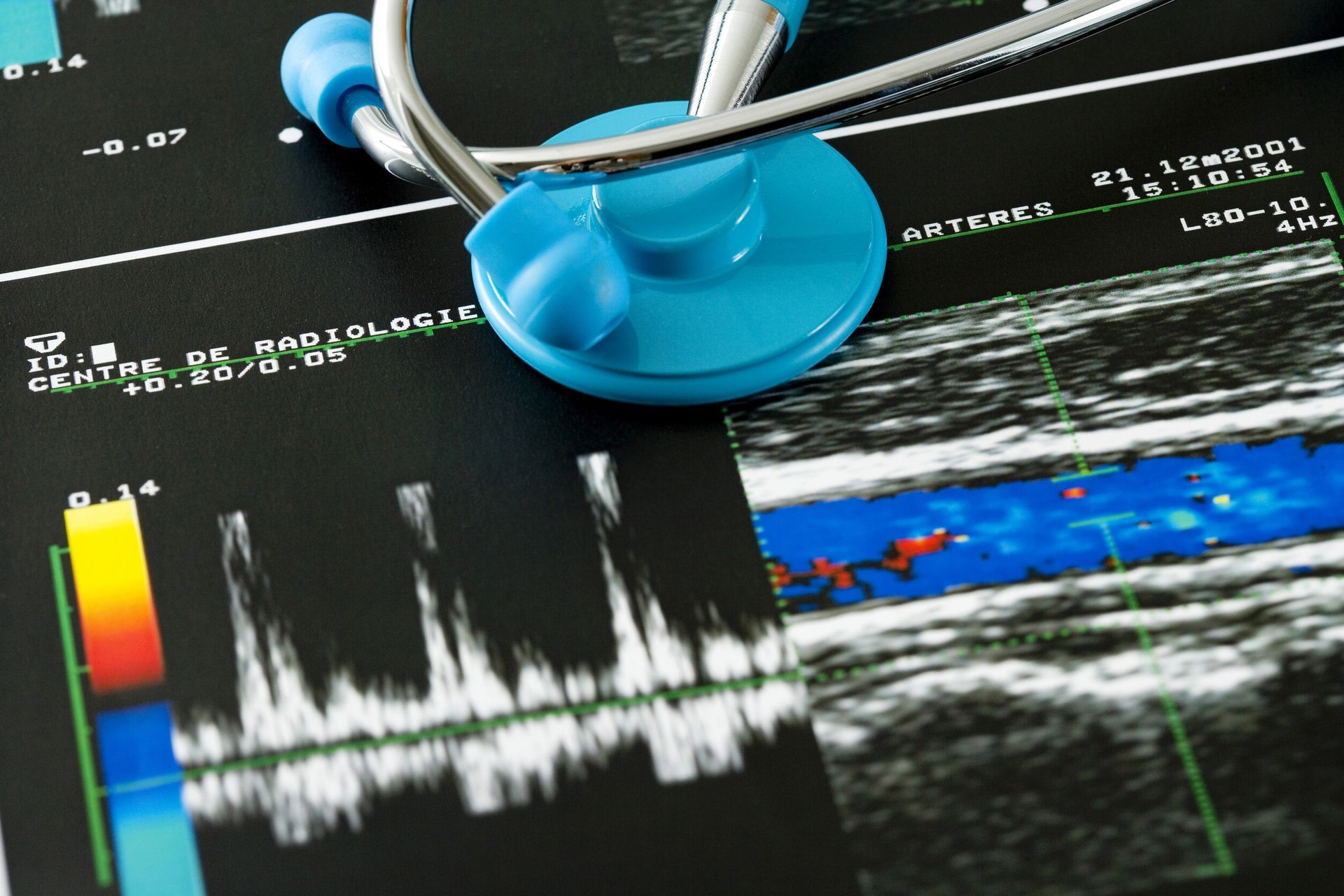 Uno stetoscopio blu è appoggiato su uno schermo per ecografia medica che visualizza la forma d'onda del flusso sanguigno e le immagini dei vasi.