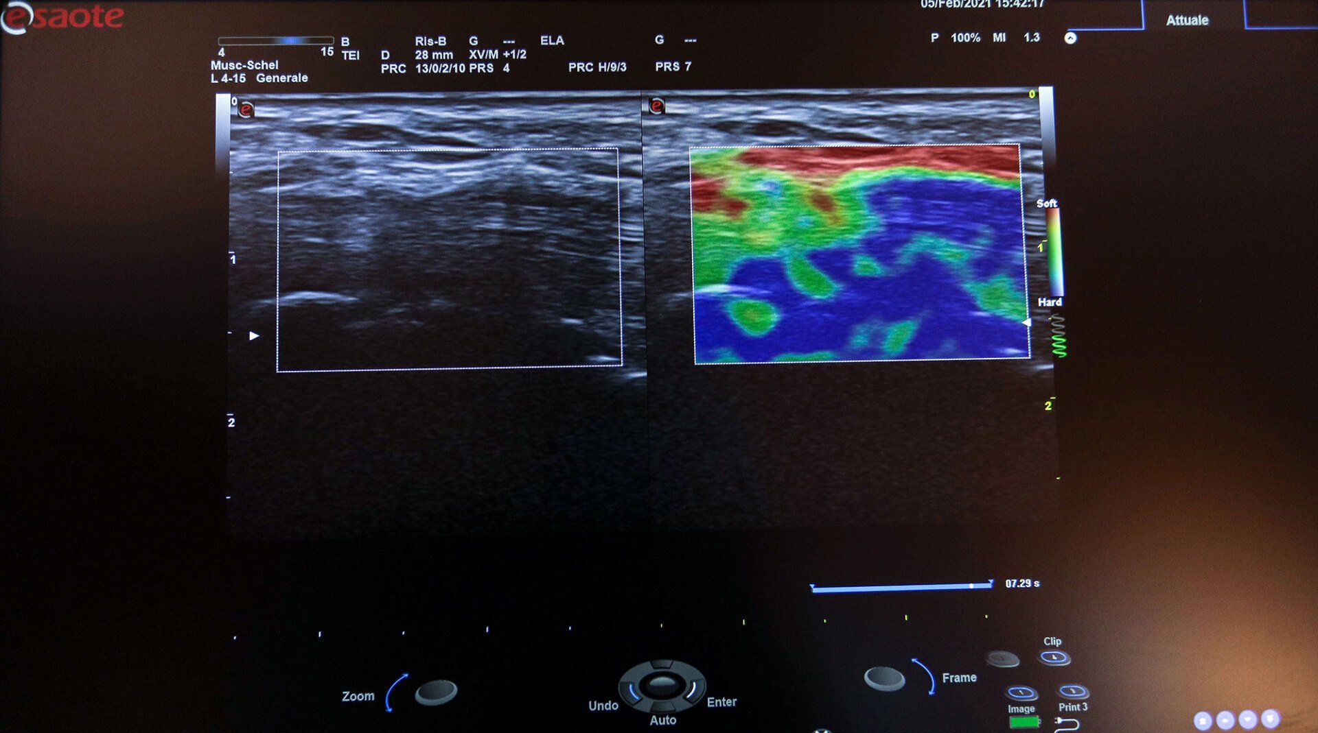 Immagine ecografica che mostra una scansione tissutale in scala di grigi a sinistra e una mappa elastografica a colori a destra.