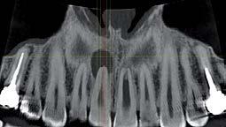 radiografia denti