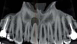 Una radiografia panoramica dentale che mostra denti e strutture ossee con una lesione circolare scura ben visibile sopra un dente frontale.