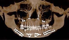 Tomografia computerizzata panoramica 3D che mostra un cranio umano con placche ortopediche metalliche e viti nella mandibola e nelle ossa facciali.