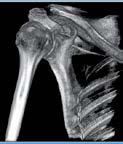 Ricostruzione TC 3D di un'articolazione della spalla umana, che mostra l'omero, la scapola e le ossa circostanti in scala di grigi.