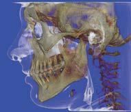 Una TAC medica 3D laterale che mostra la vista laterale di un cranio umano, della mandibola e della parte superiore della colonna cervicale su uno sfondo blu.