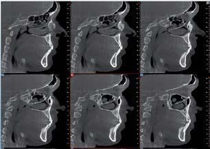 Una griglia di sei scansioni TC sagittali di un cranio umano, focalizzate sulle cavità sinusali, i passaggi nasali e la struttura dentale.