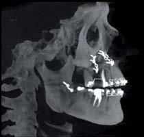Tomografia computerizzata 3D che mostra una vista laterale di un cranio umano con placche e viti di fissaggio in titanio dopo un intervento di chirurgia mandibolare.