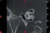Una sezione sagittale di una TAC in scala di grigi che mostra le strutture interne dell'osso temporale, inclusa la cavità dell'orecchio medio.