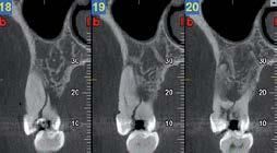 Tre sezioni trasversali di una TAC dentale in scala di grigi che mostrano la vicinanza della radice del dente al pavimento del seno mascellare.