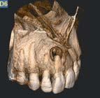Una TAC dentale 3D di una mascella superiore umana che mostra un dente con un difetto osseo circolare sopra l'apice radicolare.