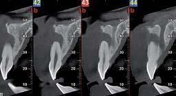 Quattro sezioni trasversali CBCT dentali sequenziali che mostrano una singola radice dentale e la struttura ossea circostante.