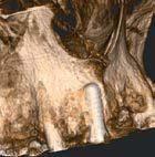 Una scansione CBCT dentale 3D che mostra un impianto dentale metallico integrato nella mascella superiore in prossimità delle radici dei denti adiacenti.