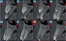 Una serie di otto sezioni trasversali di tomografia computerizzata dentale in scala di grigi che mostrano le radici dei denti e la struttura ossea circostante.
