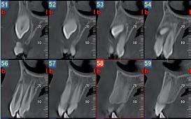 radiografia per controllo di una frattura