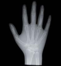 Radiografia di una mano umana che mostra le ossa delle dita, del palmo e del polso su uno sfondo nero.