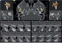 Referto di diagnostica per immagini che mostra scansioni TC assiali e sagittali dell'articolazione temporo-mandibolare (ATM) e del cranio umano.