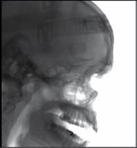 Radiografia cefalometrica laterale che mostra il cranio e le strutture dentali.