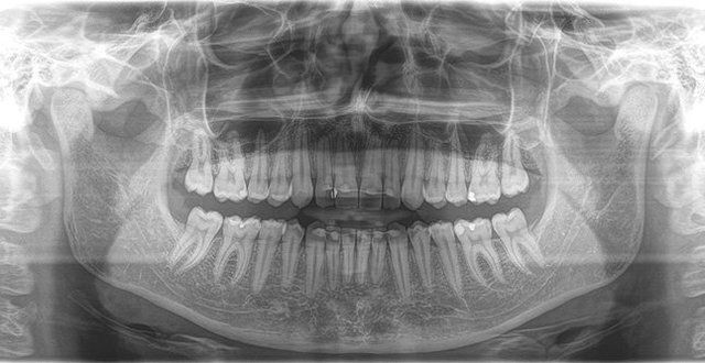 Radiografia dentale panoramica in scala di grigi che mostra i denti superiori e inferiori, la mandibola e le articolazioni temporo-mandibolari.