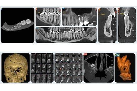 Pannelli di una tomografia computerizzata a fascio conico (CBCT) dentale che mostrano varie viste di denti, strutture mascellari e una ricostruzione 3D di un cranio umano.