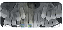 Una radiografia panoramica dentale che mostra i denti permanenti in eruzione e i denti decidui ancora presenti, contrassegnati con i numeri 50 e 60.