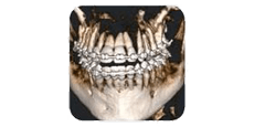 Una scansione TC a fascio conico 3D di denti umani che mostra le mascelle superiore e inferiore con apparecchi ortodontici applicati.