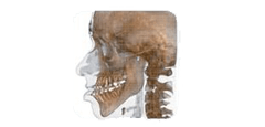 Scansione medica 3D laterale che mostra un cranio umano, una mandibola e la parte superiore della colonna cervicale con allineamento dentale.