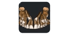 Una serie di otto sezioni trasversali CBCT dentali che mostrano la struttura di una radice dentale e un dente incluso associato.