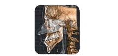 Una TAC medica 3D laterale che mostra il profilo laterale di un cranio umano, della mandibola e della colonna cervicale.