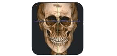 Ricostruzione 3D di una TAC di un cranio umano, vista frontale, con linee intersecanti centrate sulle orbite oculari.