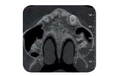 Tomografia computerizzata assiale dentale che mostra una sezione trasversale del mascellare superiore con un impianto radiopaco nella regione anteriore.