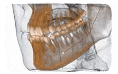 Una TAC dentale 3D di una mandibola umana che mostra i denti e un sottile filo metallico o una sonda che si estende dalla zona dei premolari.