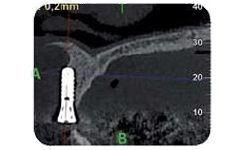 Tomografia computerizzata dentale che mostra la posizione pianificata di un impianto dentale in relazione all'anatomia della mandibola e al pavimento del seno mascellare.