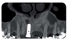 Una scansione CBCT dentale che mostra un impianto metallico nella mascella superiore, posizionato vicino alla cavità sinusale e ai denti adiacenti.